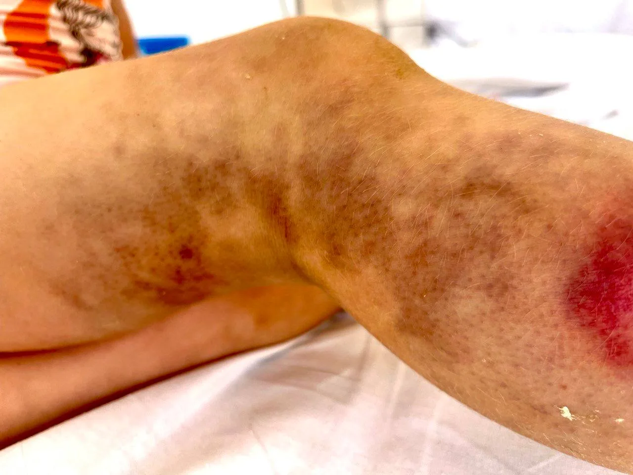 Врачи Люберец призывают родителей после укуса ребенка змеей сразу обращаться в больницу