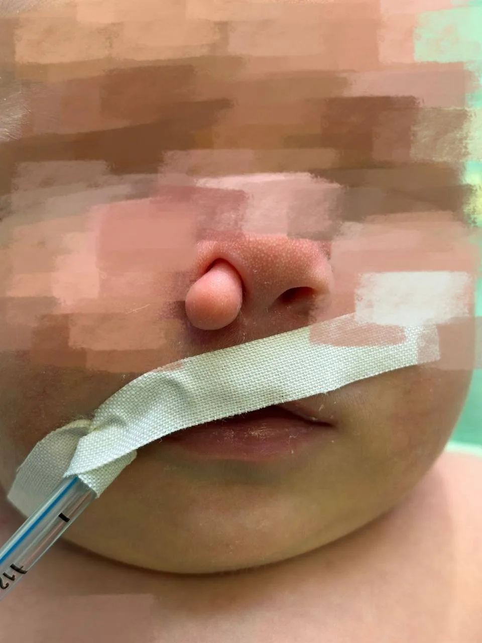 Неонатальные хирурги МОЦОМД вернули возможность дышать носом новорожденному ребенку